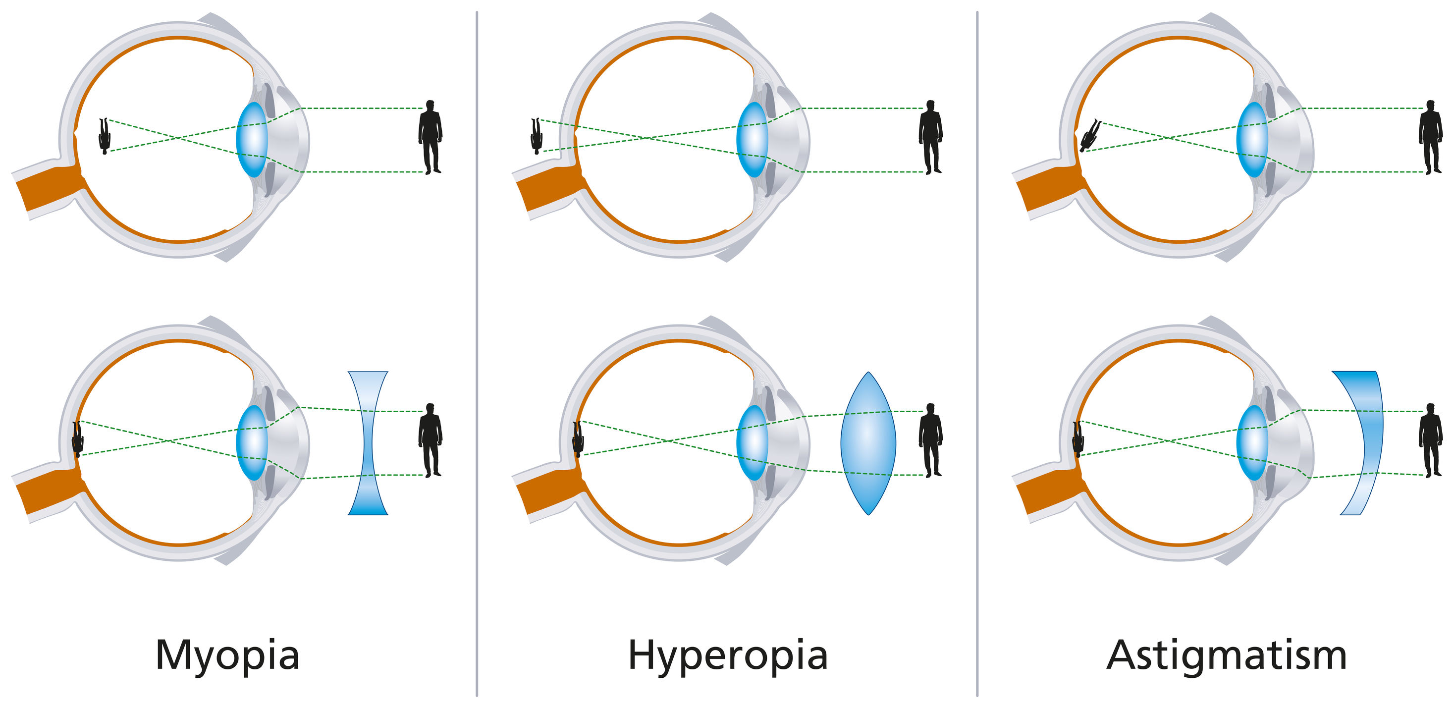 Készülékek strabismus myopia kezelésére - Myopie astigmatismus ou