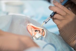 Le traitement de la presbytie par la pose d’implant multifocal