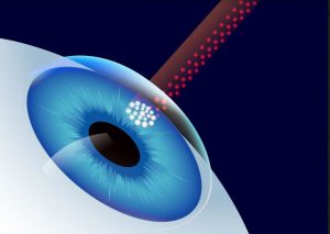 Les rayons UV et l’œil