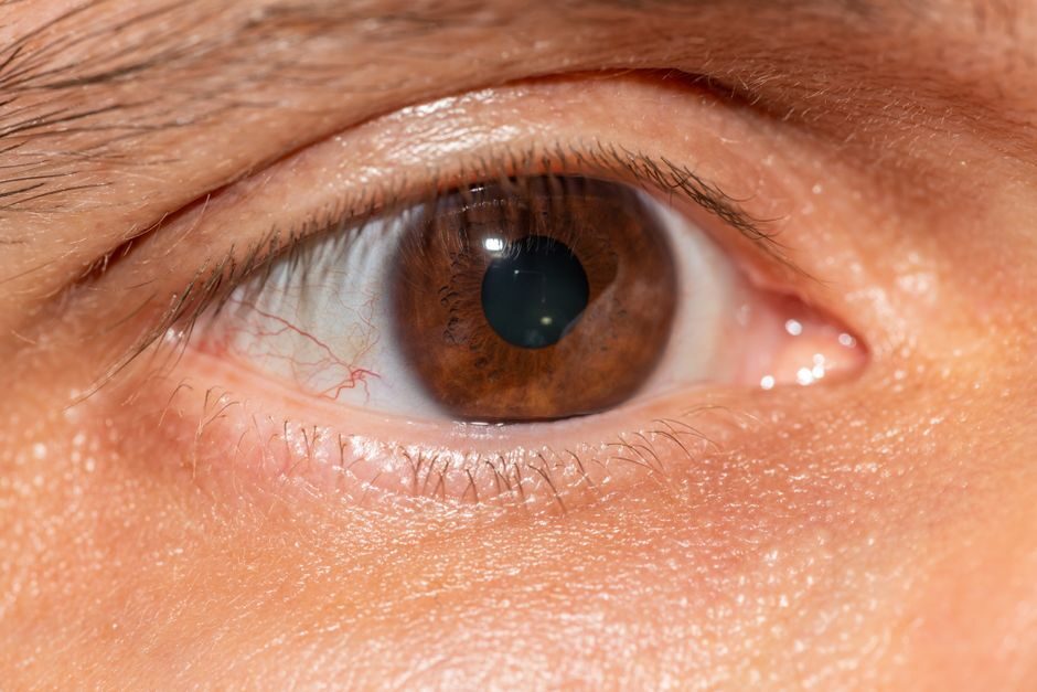 découvrez tout sur le kératocône, une maladie de l'œil affectant la forme de la cornée, ses symptômes, causes et traitements.