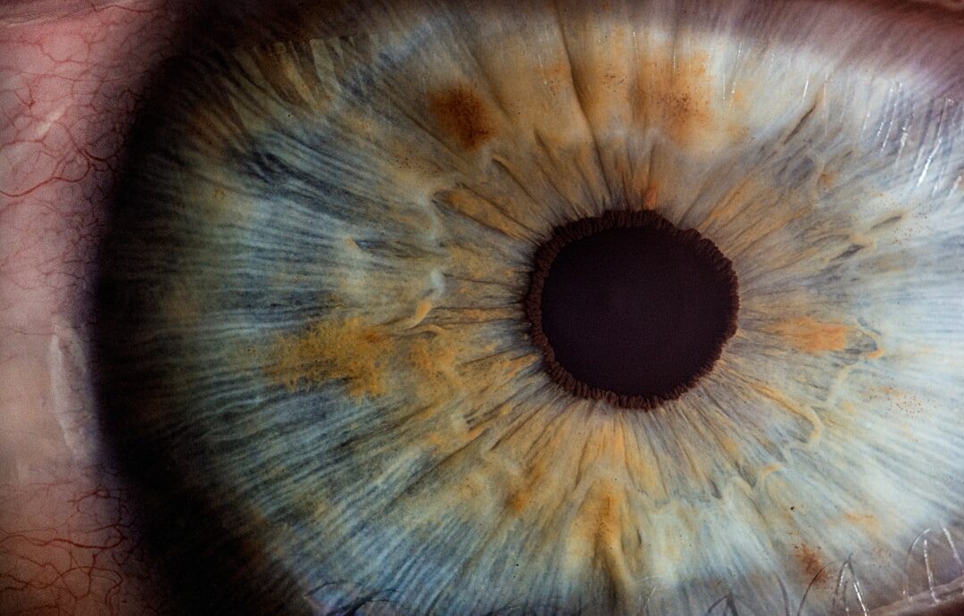 le syndrome de l'œil sec est une affection caractérisée par une diminution de la production de larmes, entraînant une sensation d'inconfort et de sécheresse oculaire.