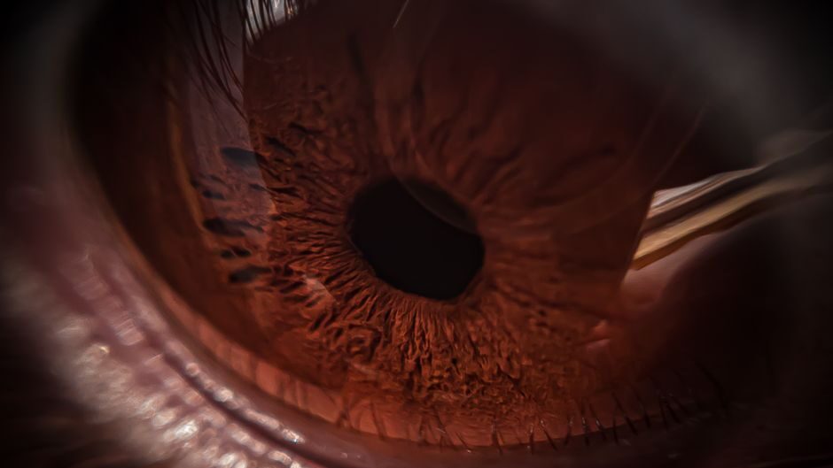 découvrez tout sur la pkr (photorefractive keratectomy) : procédure de correction de la vision, avantages et inconvénients, et informations importantes à savoir.
