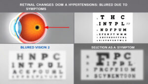 découvrez les symptômes oculaires de l'hypertension et apprenez comment cette condition peut affecter votre vision. informez-vous sur les signes d'alerte à surveiller et l'importance d'un suivi médical préventif.