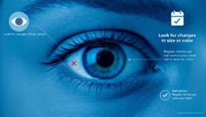 découvrez les implications médicales d'un grain de beauté dans l'œil. informez-vous sur les signes à surveiller et quand consulter un professionnel de santé pour évaluer le risque de cancer.