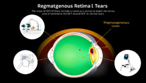 découvrez comment détecter une lésion rhegmatogène liée aux déchirures de la rétine. informez-vous sur les symptômes, les méthodes de diagnostic et l'importance d'une consultation ophtalmologique rapide pour préserver votre vision.